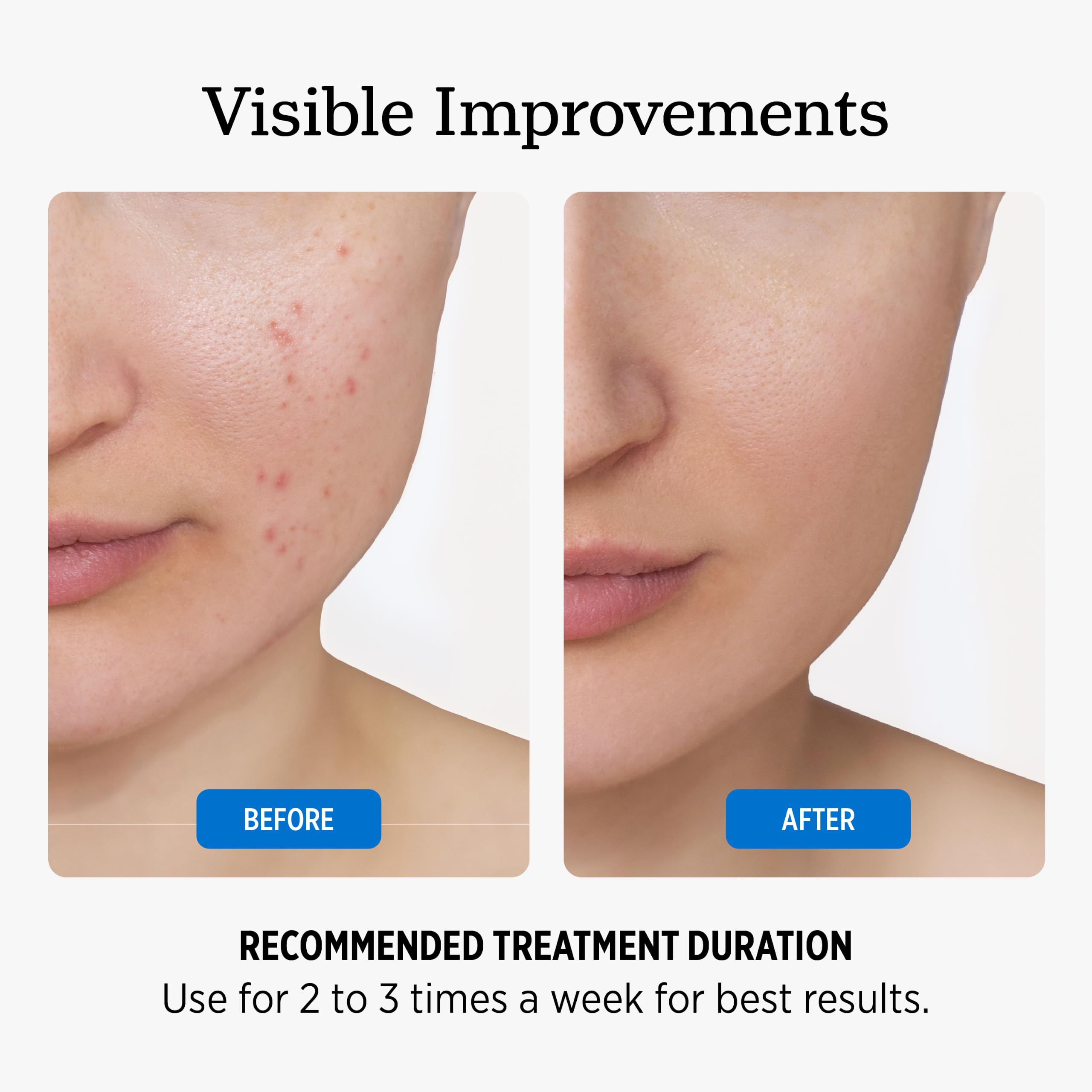 NUVADERMIS application on face illustrating gentle resurfacing benefit