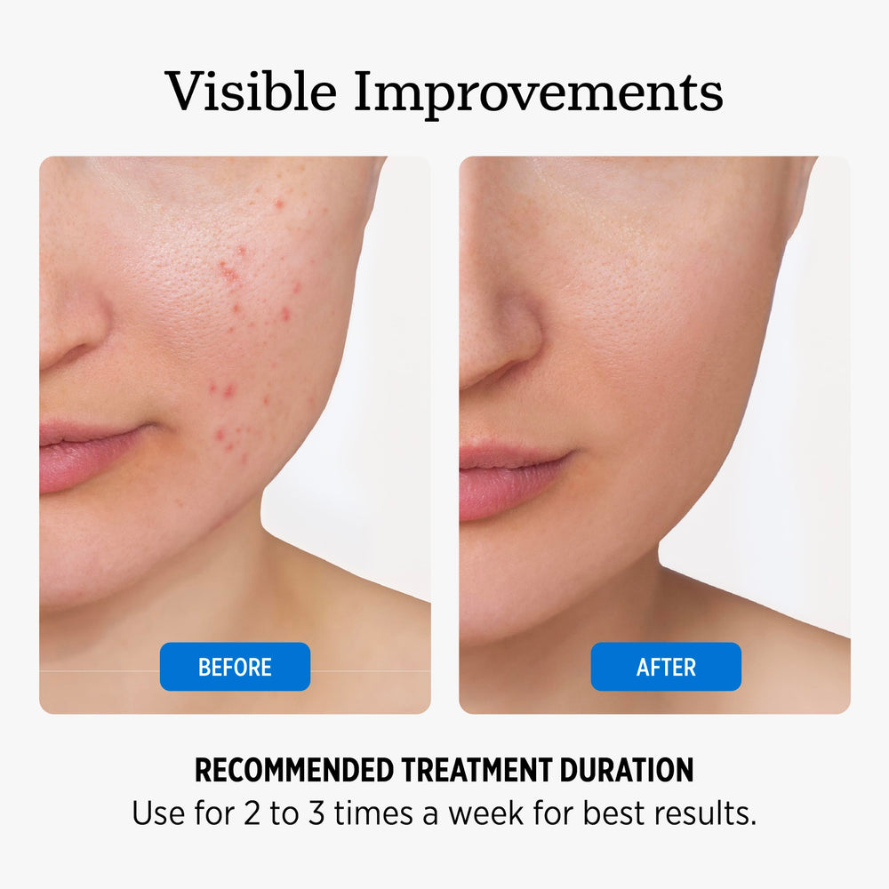 NUVADERMIS application on face illustrating gentle resurfacing benefit