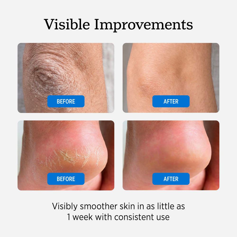 NUVADERMIS tube next to socks indicates overnight treatment routine