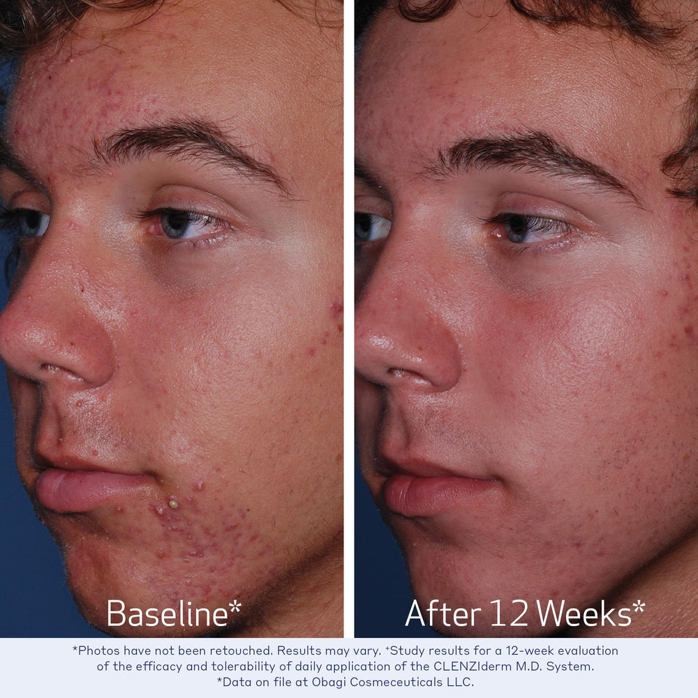 Obagi Medical CLENZIderm M.D. being applied to cotton pad demonstrating easy application and pore-clearing benefit