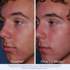Obagi Medical CLENZIderm M.D. being applied to cotton pad demonstrating easy application and pore-clearing benefit
