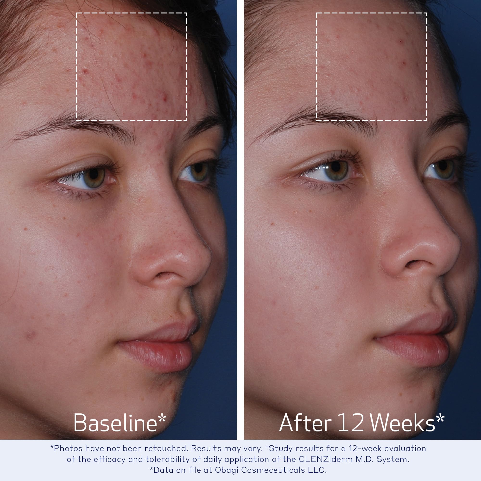 Foamy texture from Obagi cleanser on hand demonstrating gentle cleanse