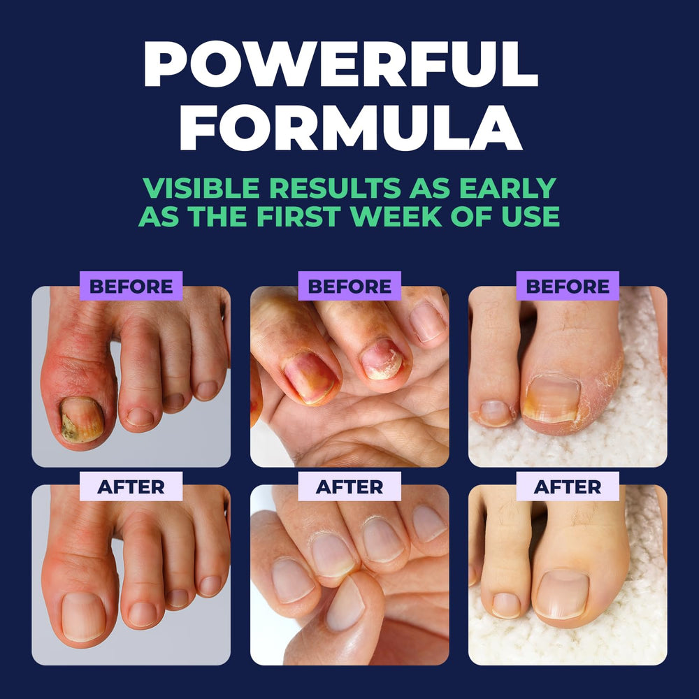 Orivelle before and after nails displaying improved tidy and smooth look