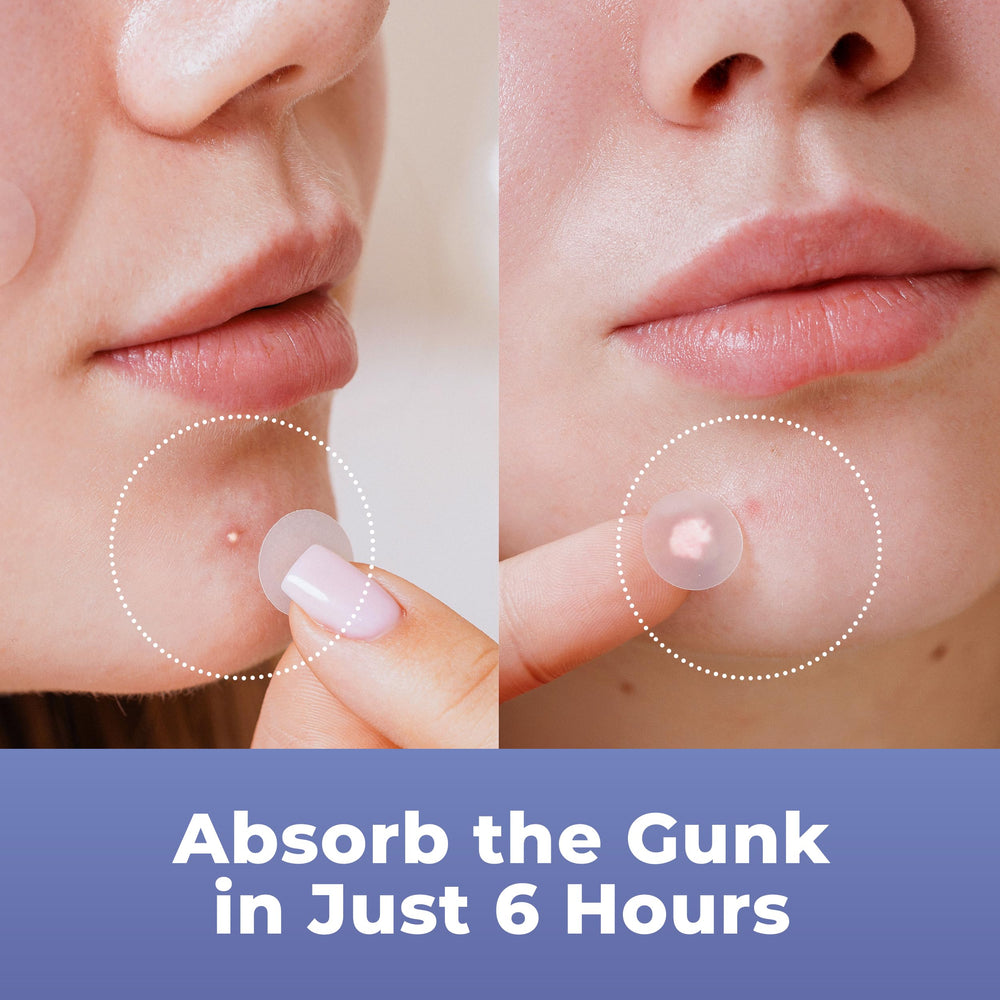 PatchRx patch on cheek during daytime illustrating subtle coverage under makeup