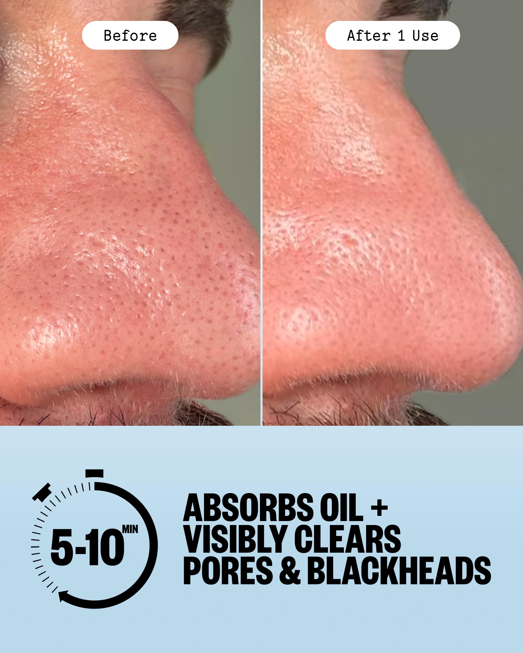 PEACE OUT disposable extractor tool detail for safer blackhead removal