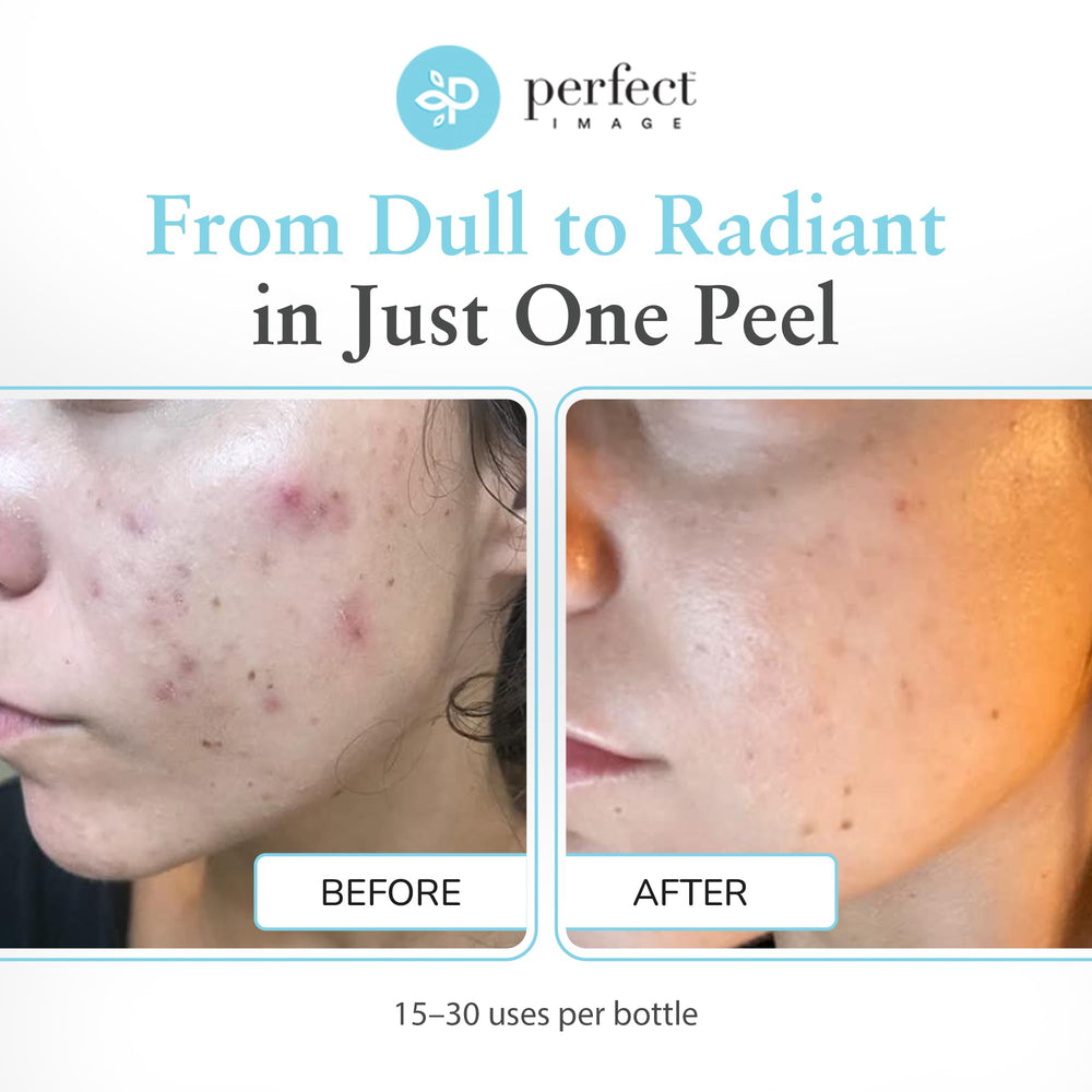 Perfect Image professional applying 30% glycolic gel peel demonstrating controlled treatment