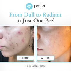 Perfect Image professional applying 30% glycolic gel peel demonstrating controlled treatment