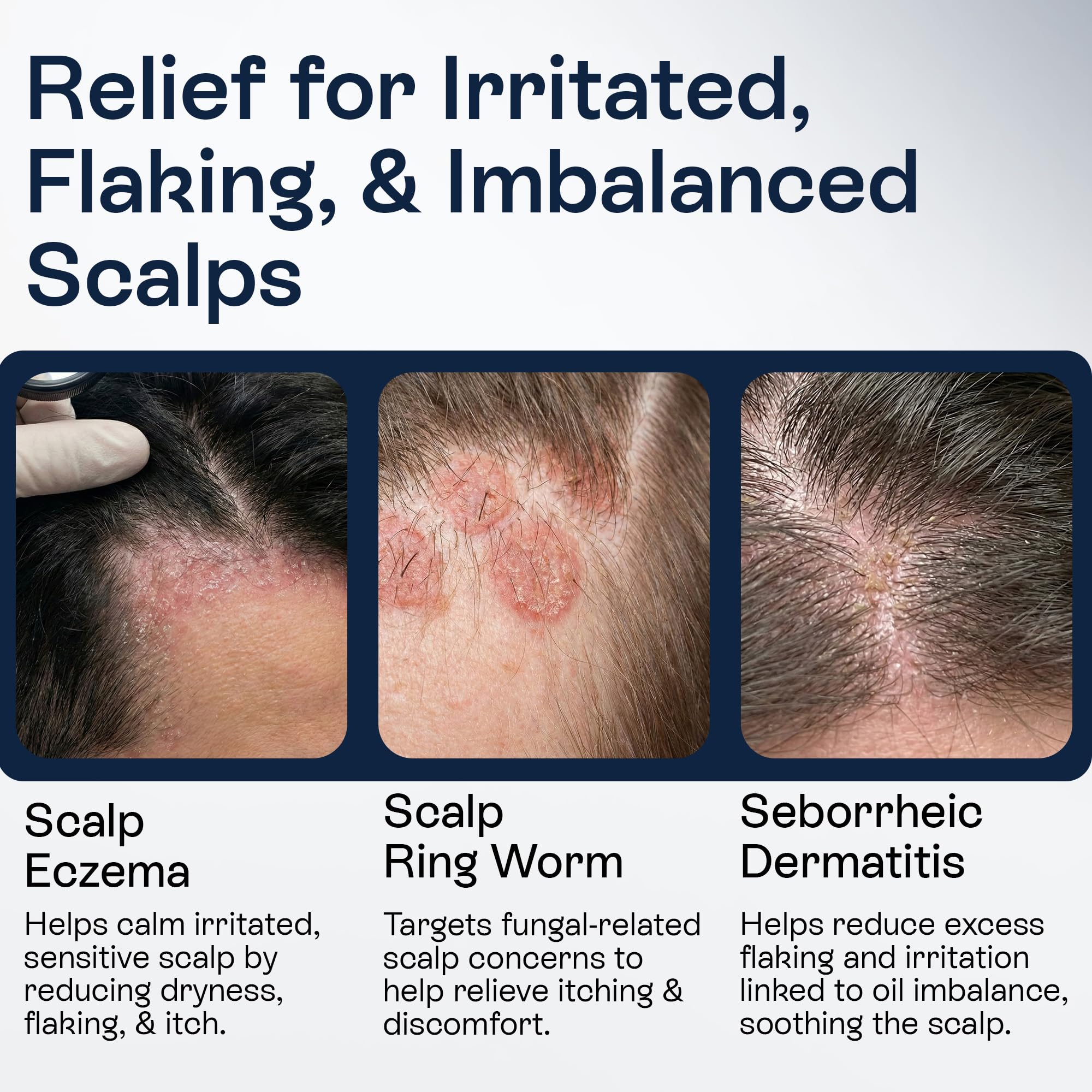 Pharmlitalia being applied to scalp for focused flake relief