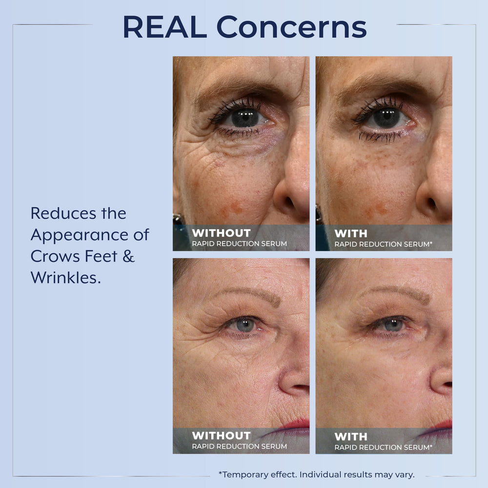 Plexaderm before and after comparison showing reduced under-eye bags