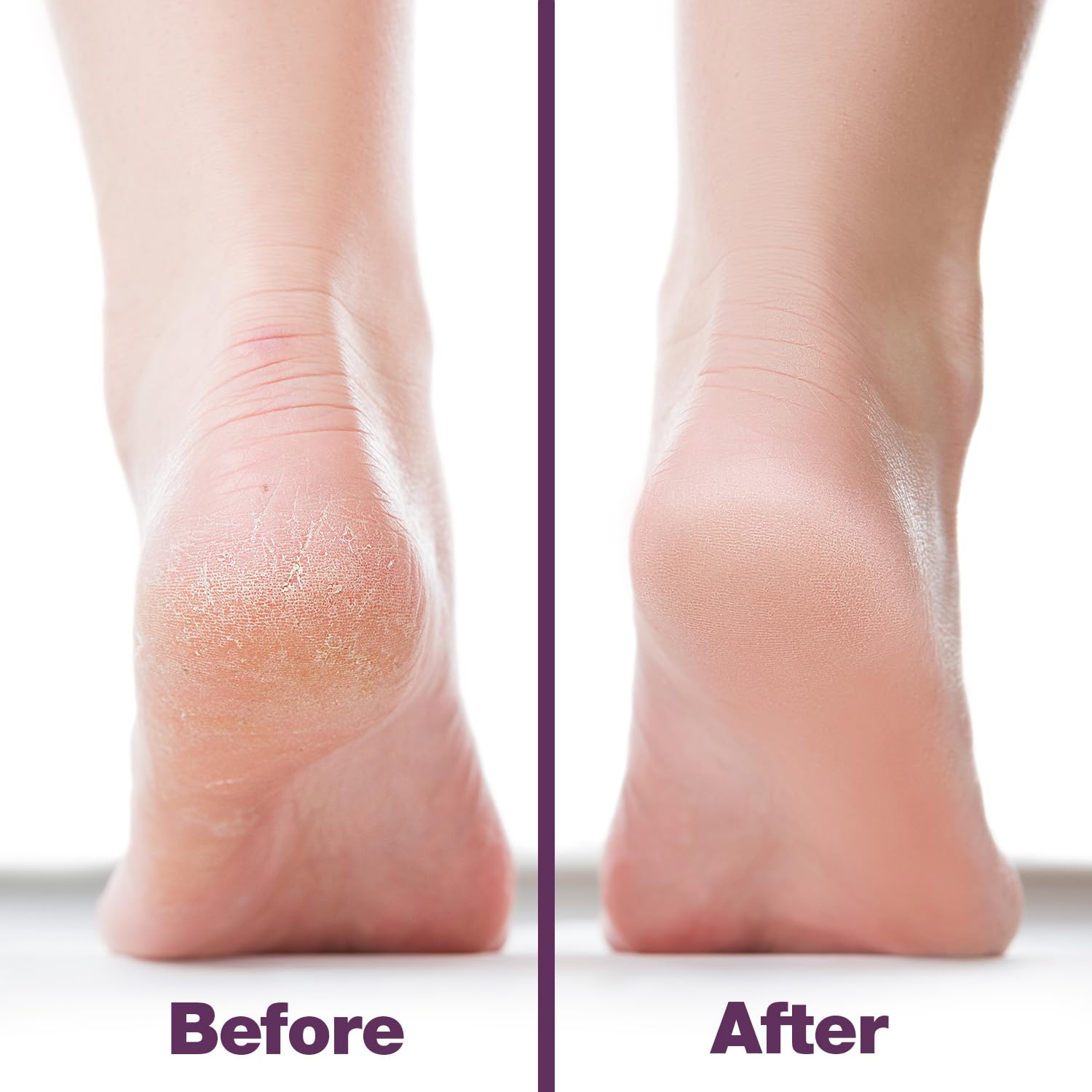 Probelle foot file in use on heel demonstrating quick dead skin reduction