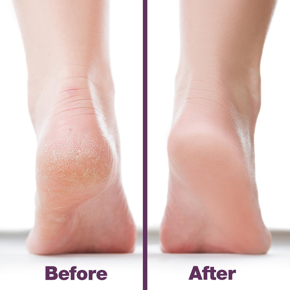 Probelle foot file in use on heel demonstrating quick dead skin reduction