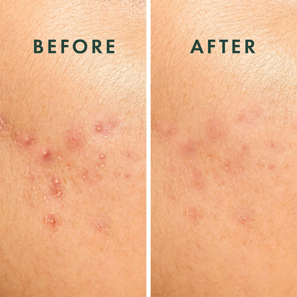 Rael patch with visible absorption showing fluid removal benefit