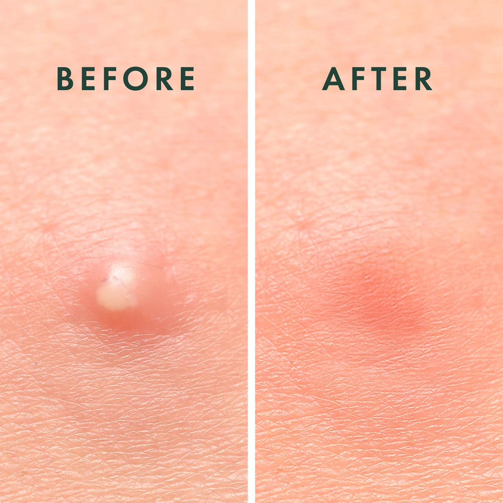 Rael patch on skin close-up demonstrating discreet coverage benefit
