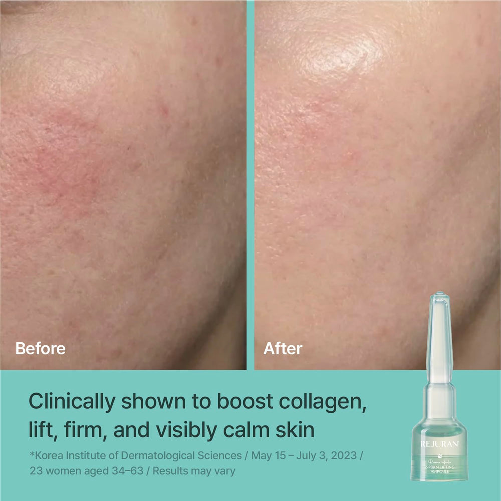 REJURAN ampoule application on face demonstrating soothing hydration benefits