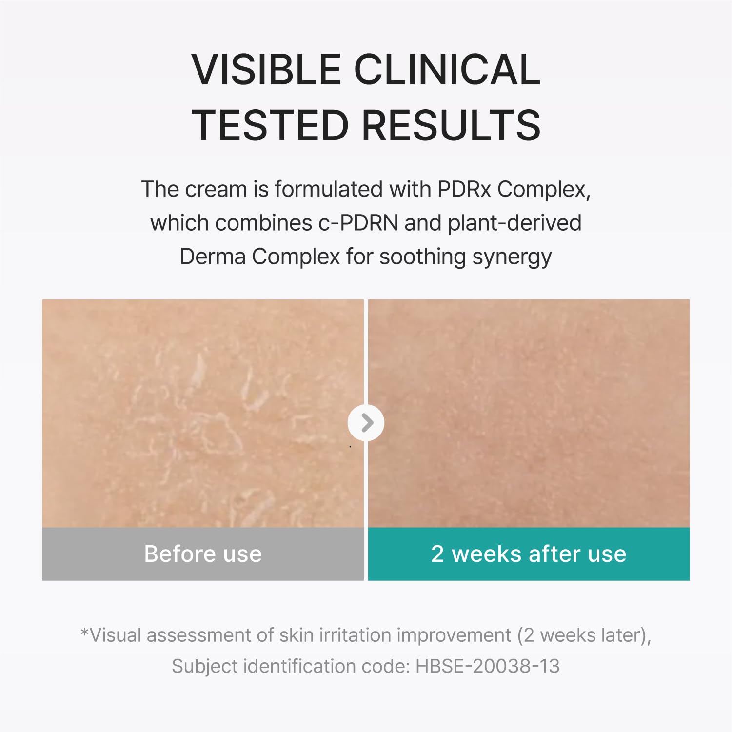 REJURAN dispensed cream on fingertip demonstrating easy application and moisture