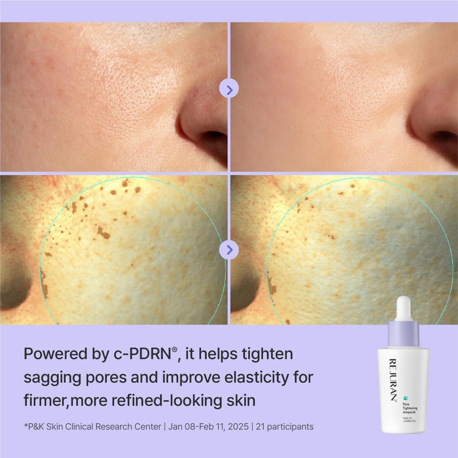 REJURAN ampoule held in hand showing size and easy dosing