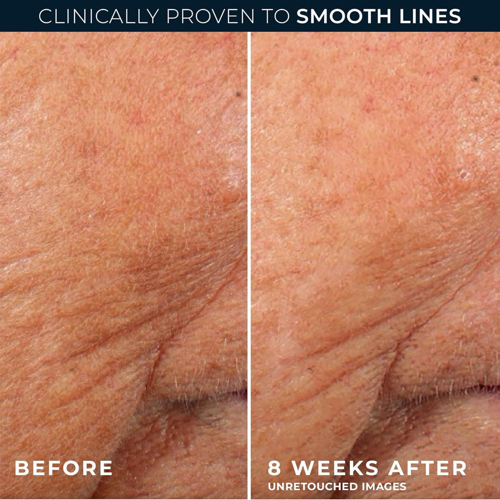 RoC applied to face and neck at night for targeted wrinkle support