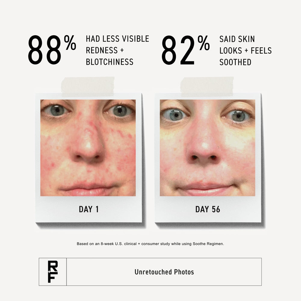RODAN + FIELDS cream applied on hand demonstrating gentle hydration and skin comfort
