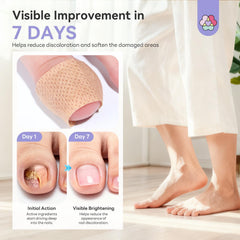 SAVILAND patch applied on toenail demonstrating discreet coverage