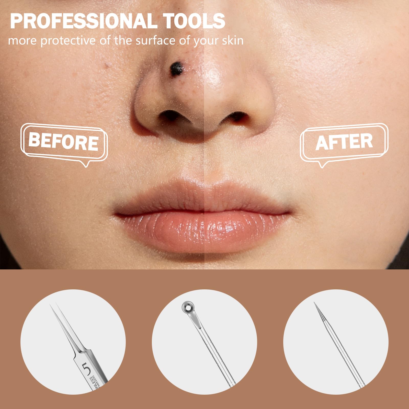 Screwizard tool in use on nose demonstrating targeted extraction with reduced skin trauma