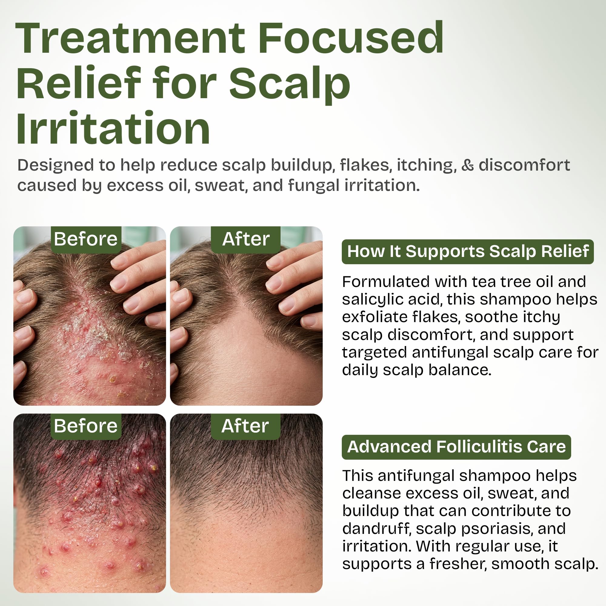 Applying Shailee shampoo with scrubber for improved scalp contact
