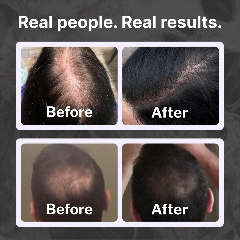 Shapiro MD shampoo in hand during wash showing improved scalp coverage
