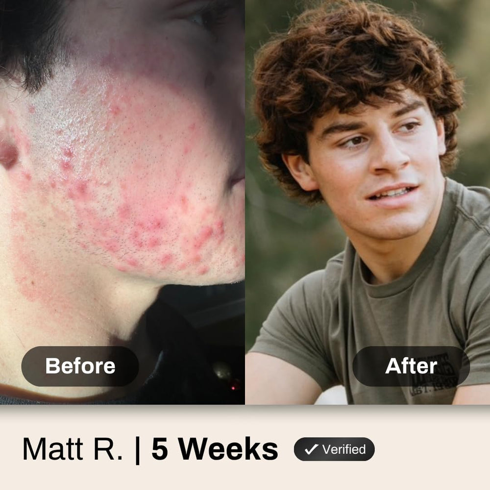 Shield illustrative before and after showing reduced redness and blackheads
