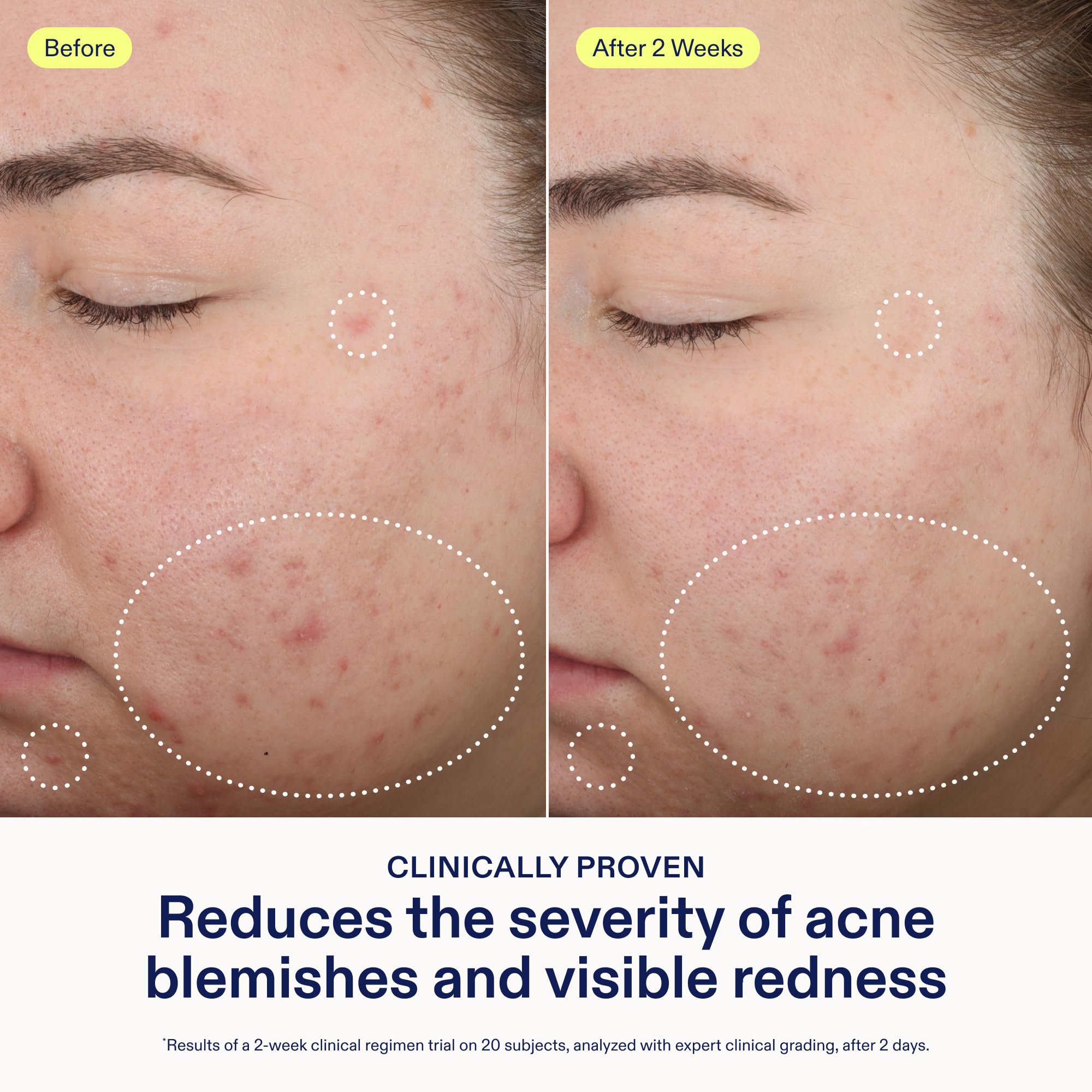 Skinfix applying a dot to a facial blemish for targeted treatment