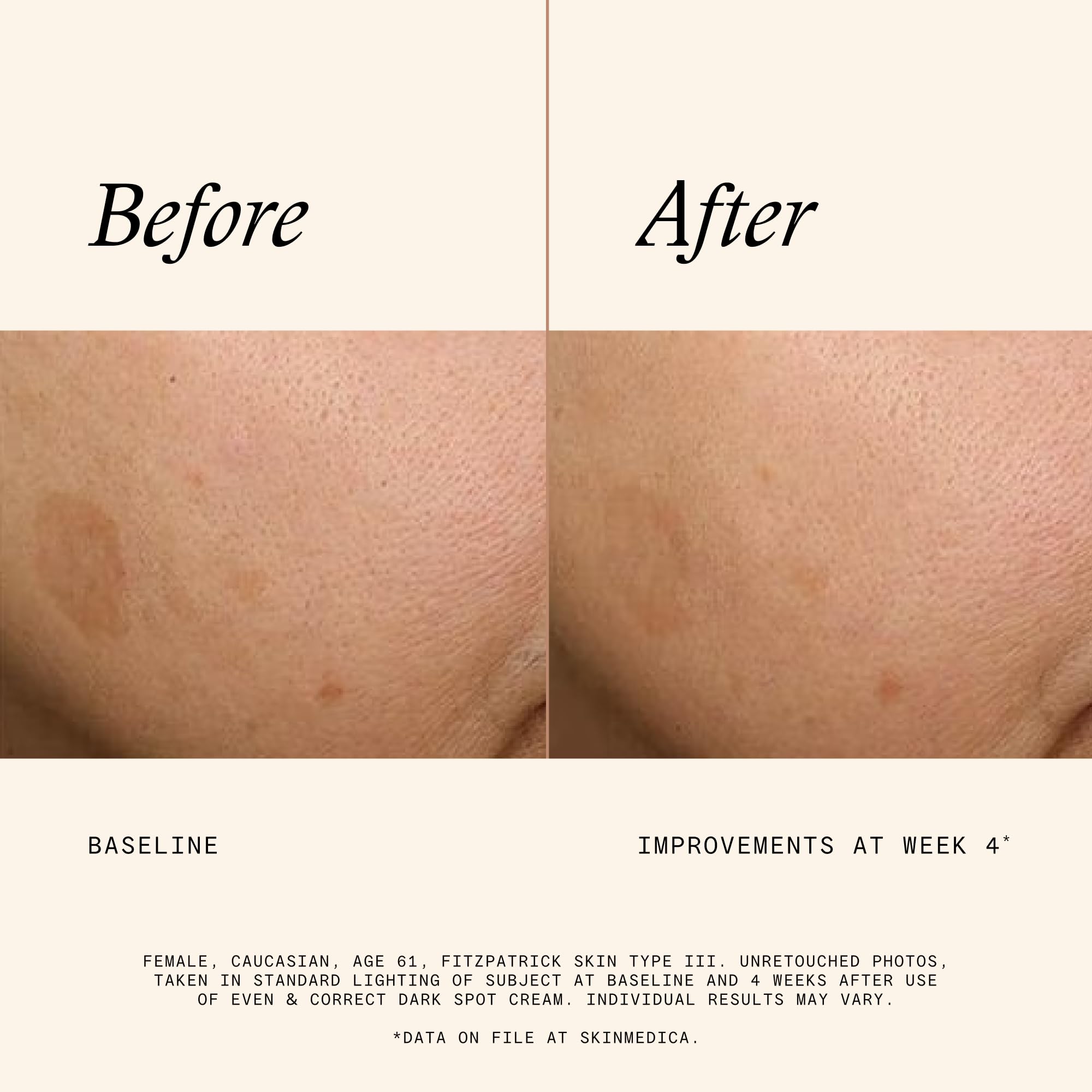 SkinMedica before and after comparison illustrating reduced dark spots and improved tone