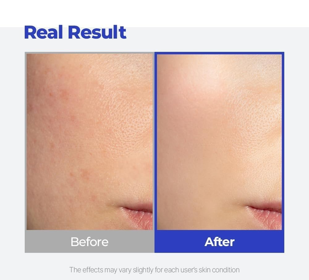 SKINSINS in a handbag illustrating on-the-go acne care convenience