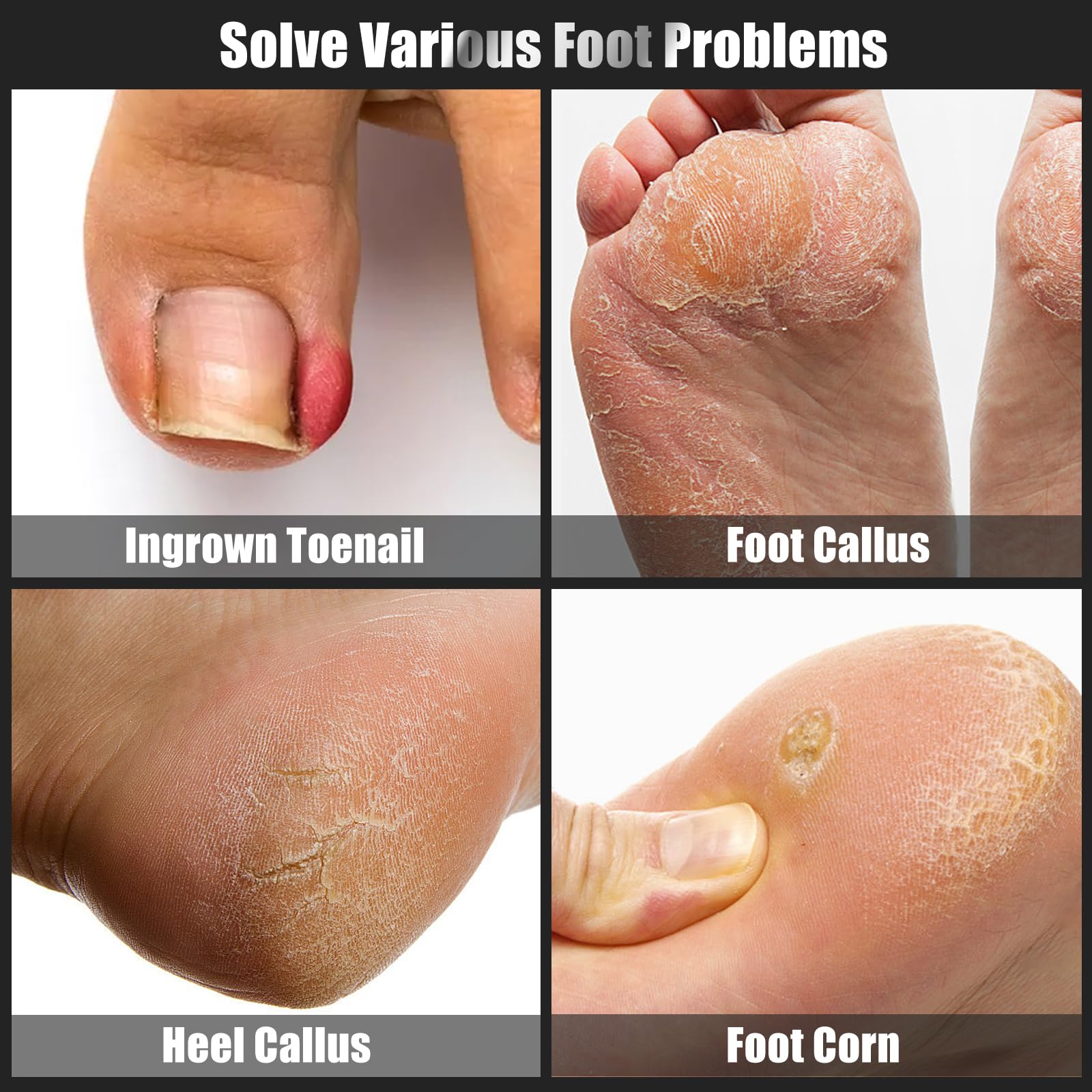 SMZHealing double-headed ingrown toenail lifter detail demonstrating gentle lifting benefit
