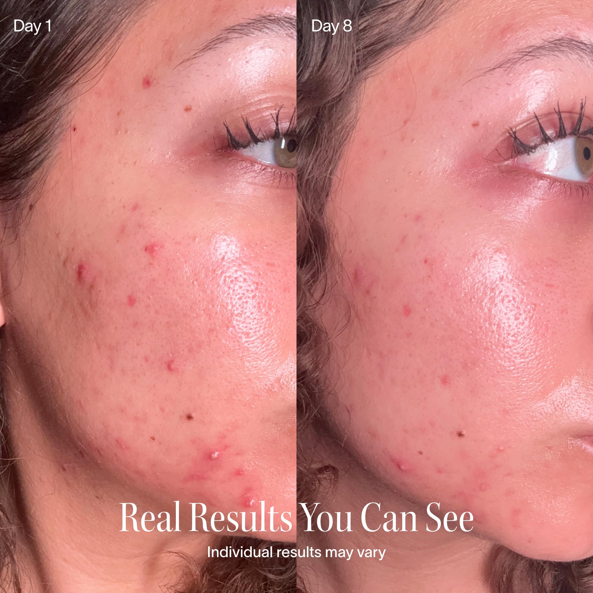 Solawave treating chin blemish showing targeted face spot treatment benefit