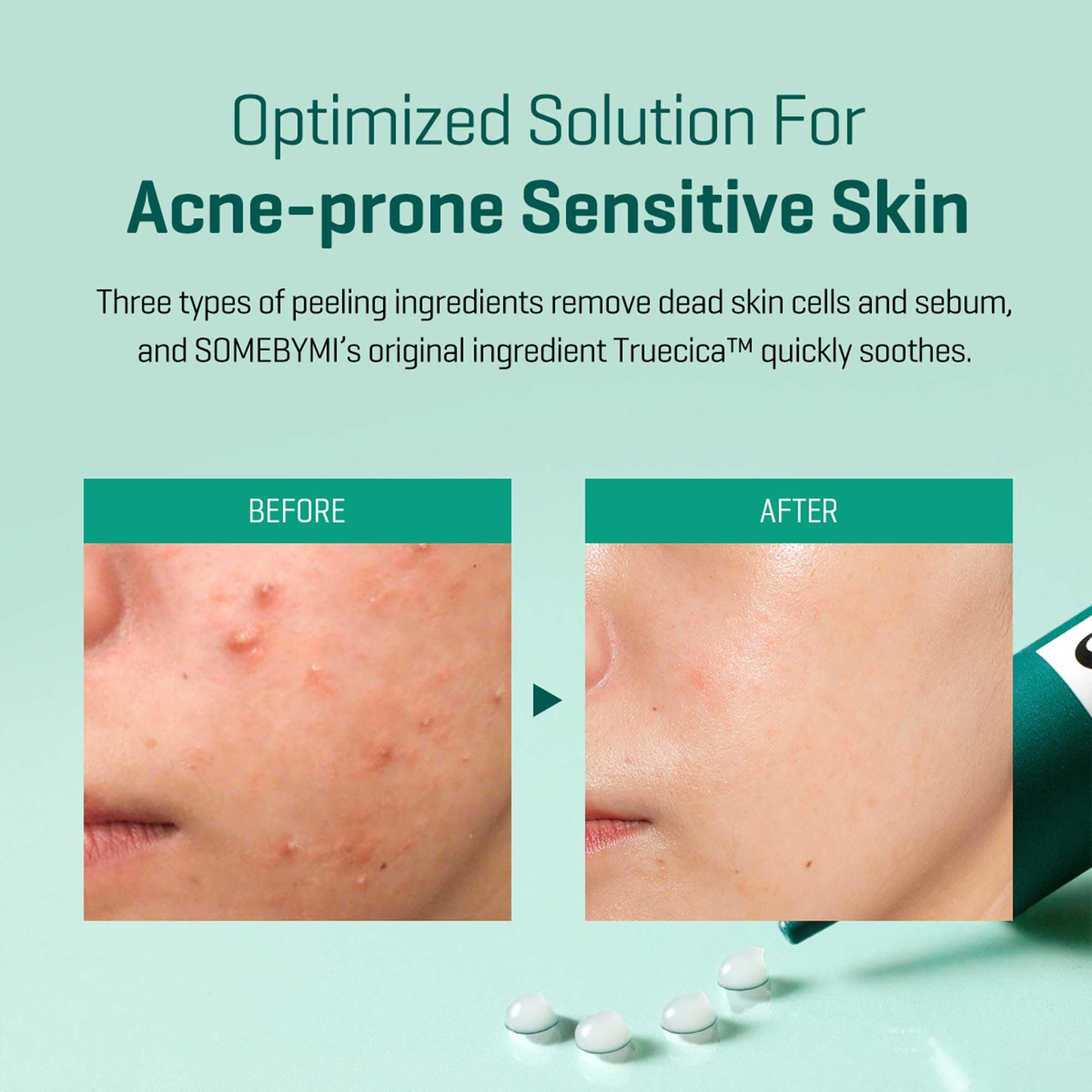 SOME BY MI applying spot cream to targeted area for quick calming