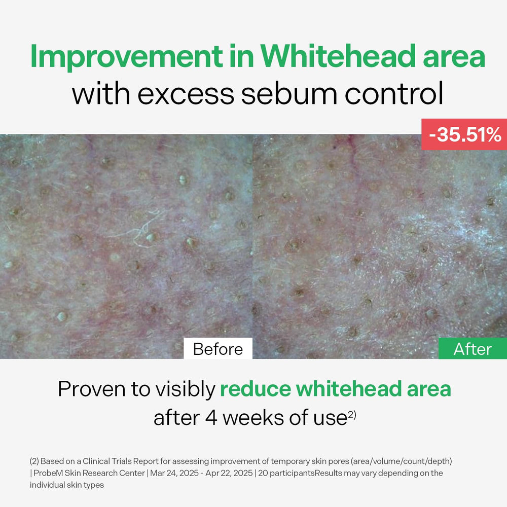 Before and after skin texture with Torriden, illustrates reduced pores