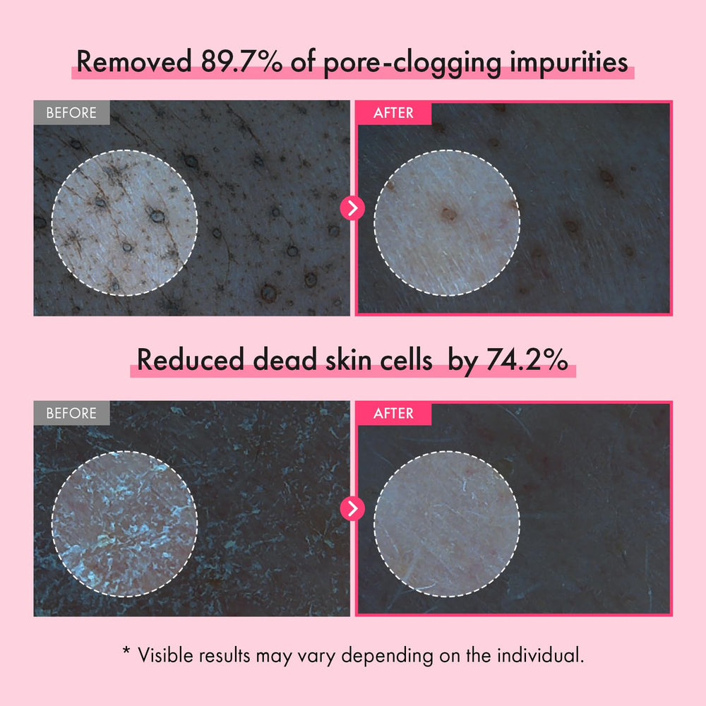 TOSOWOONG pink capsules detail highlighting blackhead-lifting action