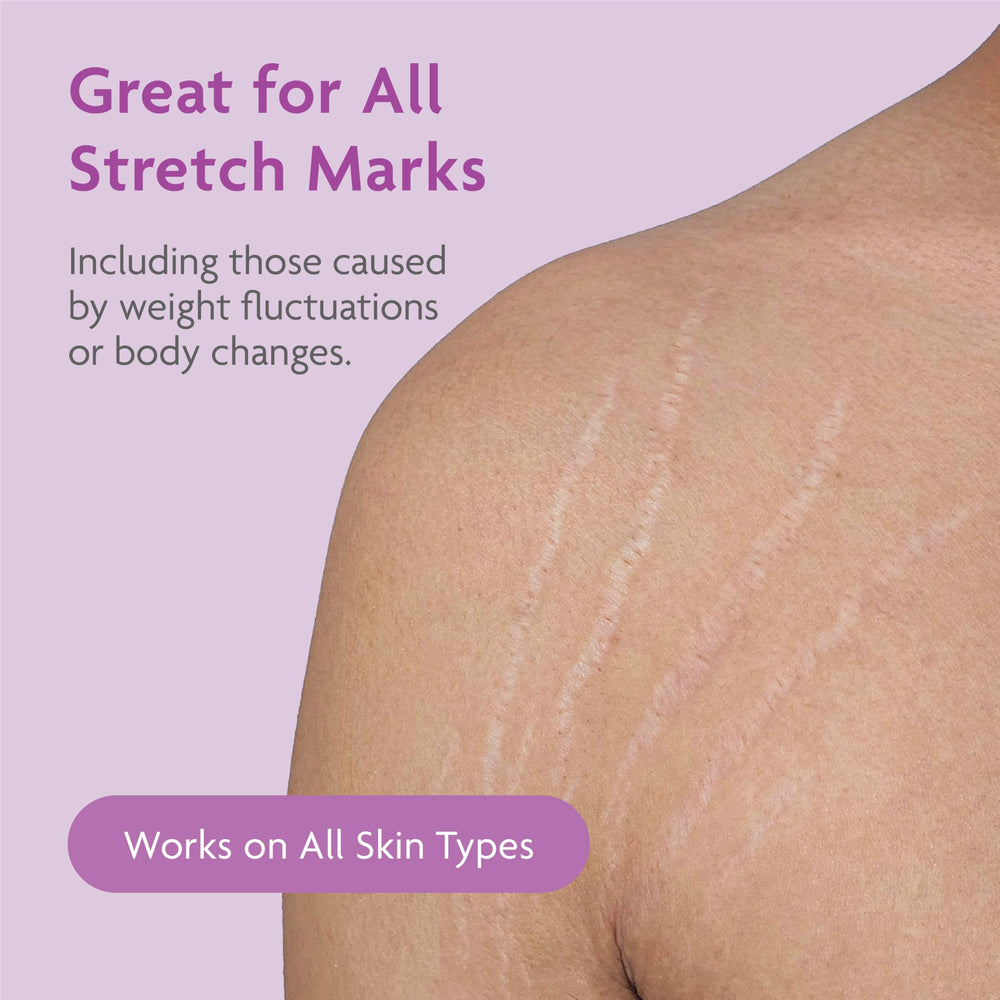 Lifestyle image of postpartum user applying TriLASTIN for daily skin care support