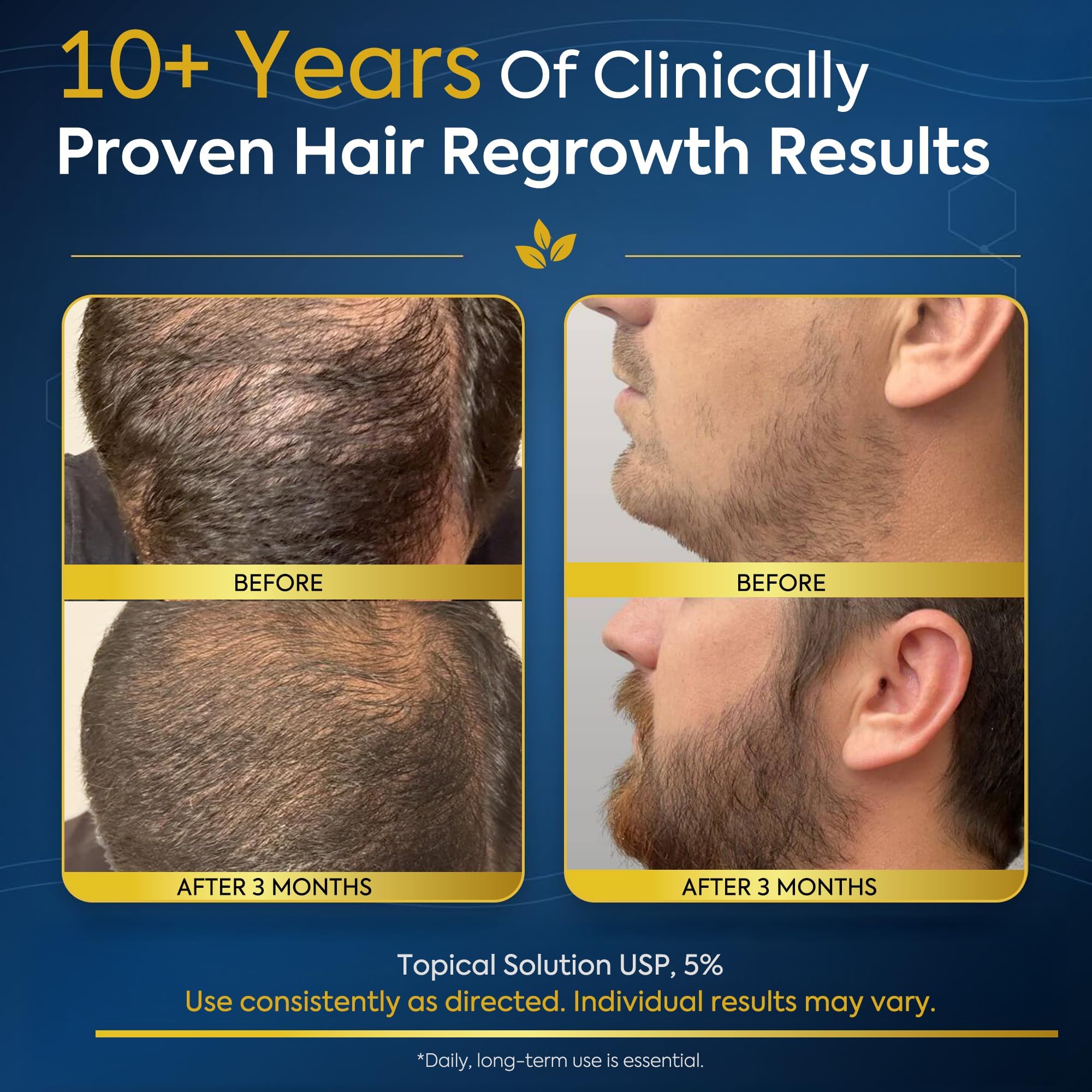 VeraRoot applying solution to cheek area to target patchy beard growth effectively