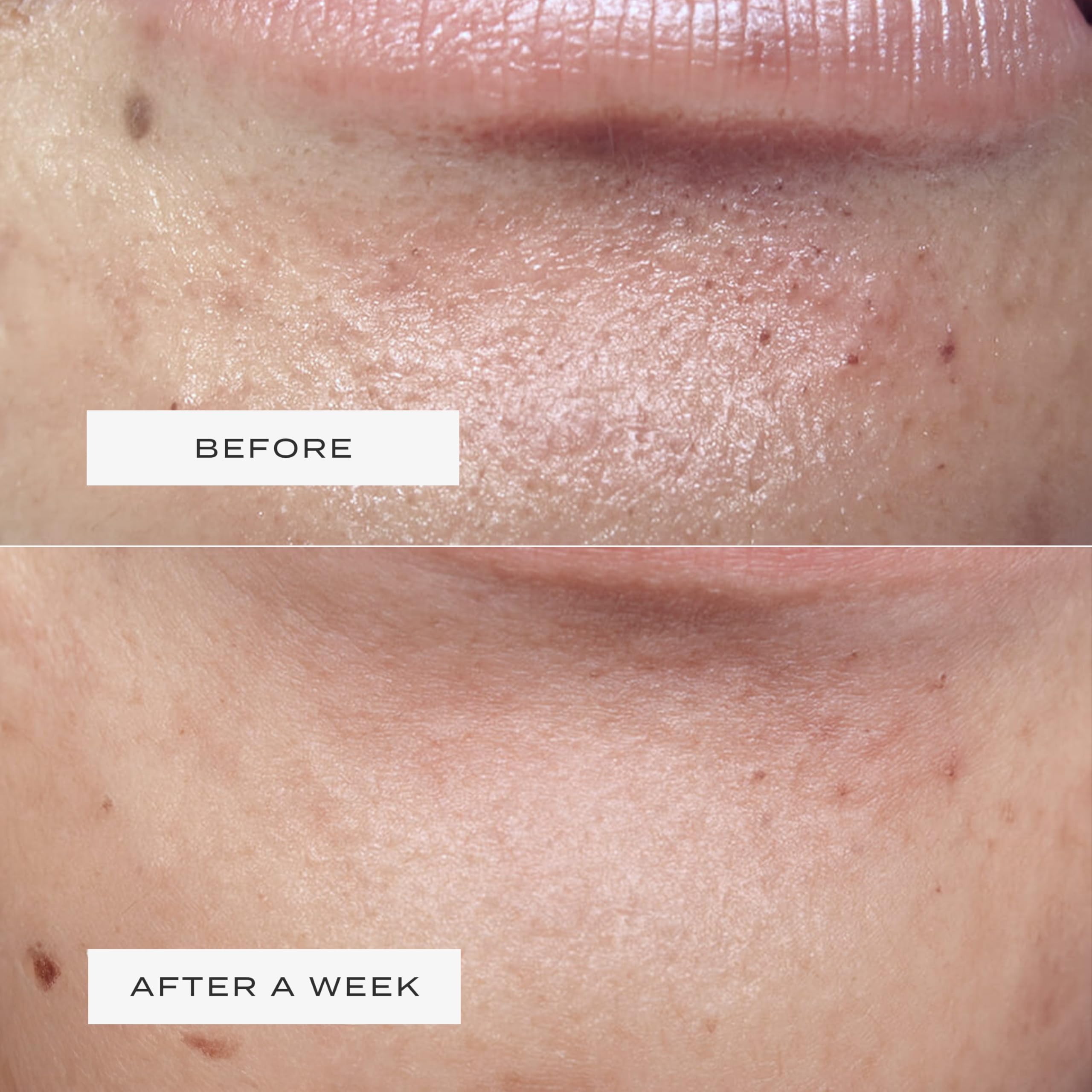 Vue detailed edge adhesion on jawline, illustrating comfortable stay-put design