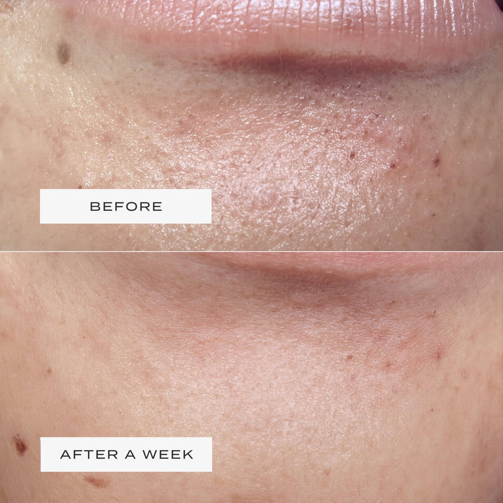 Vue detailed edge adhesion on jawline, illustrating comfortable stay-put design