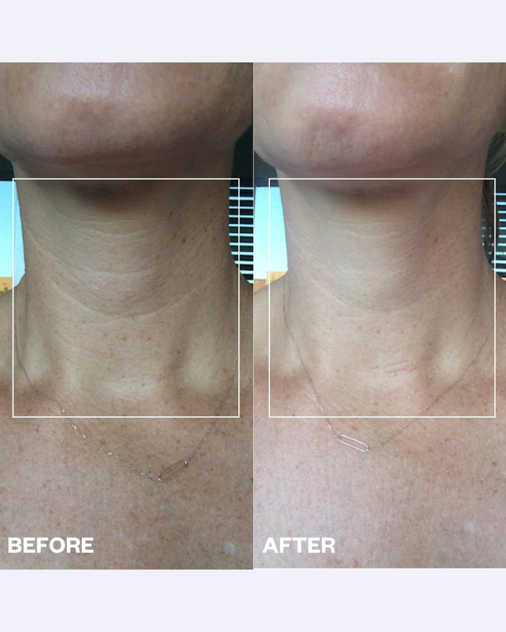 Wrinkles Schminkles patch applied on neck while sleeping for smoothing effect