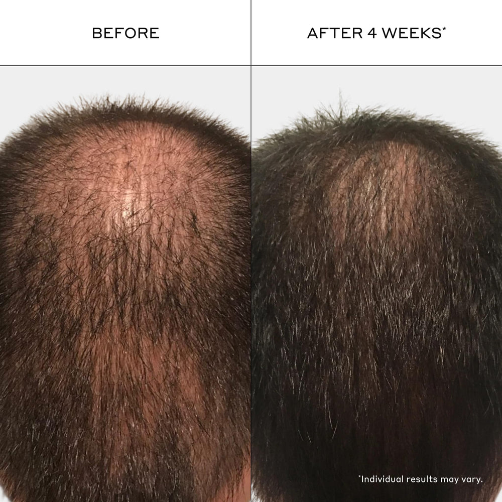 Zenagen product on head showing five-minute treatment function