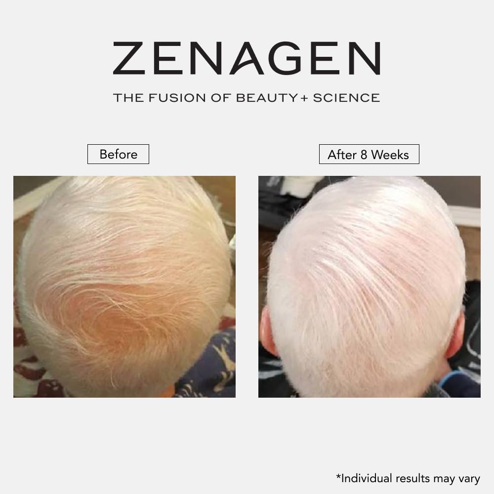 Zenagen applied to scalp showing targeted application benefit
