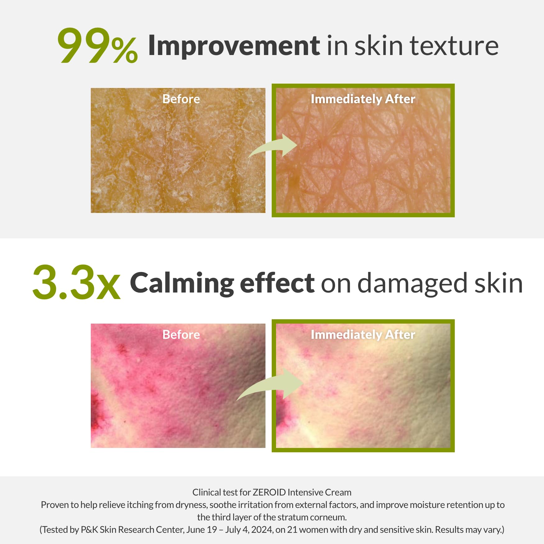 ZEROID cream being applied to cheek, demonstrates quick absorbency and comfort